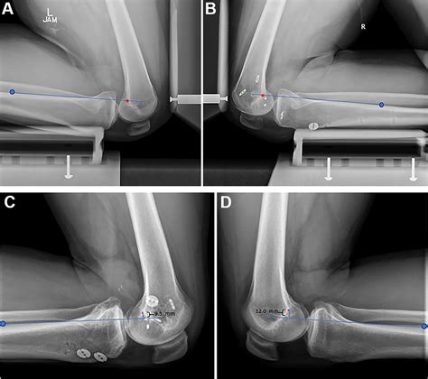 Arthroscopic Double Bundle Posterior Cruciate Ligament 52 Off