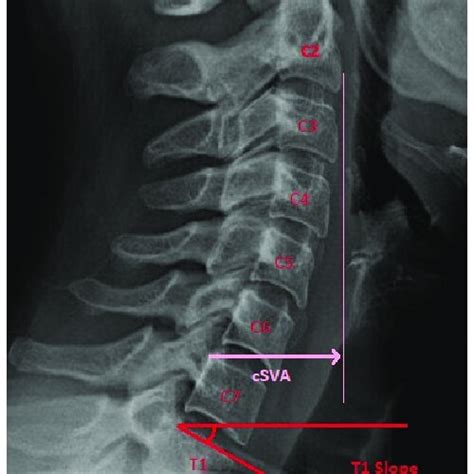 Lateral Cervical Spine Radiograph Demonstrating Cervical Sagittal