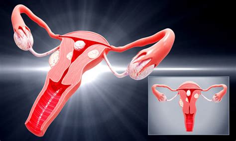 Ovarian Cancer Symptoms Feeling Bloated ‘constantly A Common Sign Of