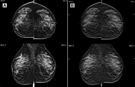 Evidence On Synthesized Two Dimensional Mammography Versus Digital