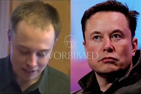 Elon Musk Hair Transplant l Before and After