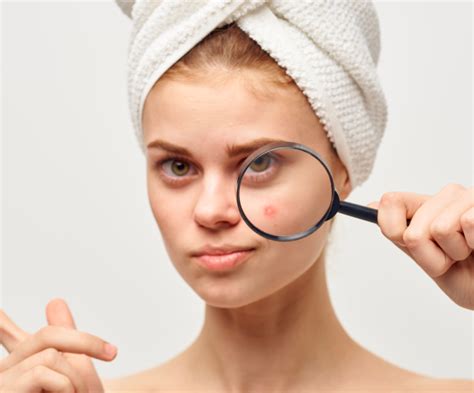 treat  zit heather  rogers md doctor rogers skin care