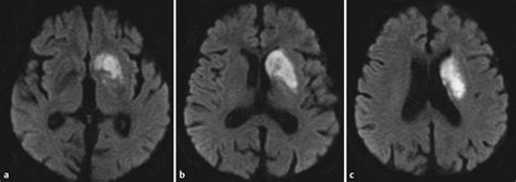 15: The Recurrent Artery of Heubner | Radiology Key