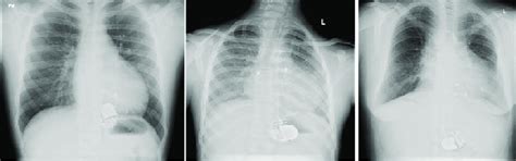 Chest x-rays, The Typical Sites of Epicardial Pacemaker Implantation ...