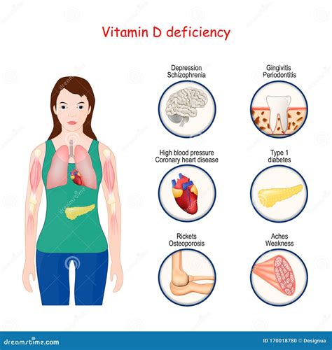 Deficiencia De Vitamina D Cuerpo Humano Y Cierre De órganos Con