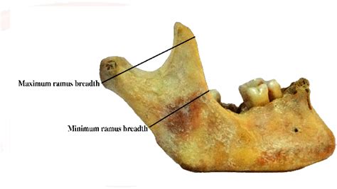 Figure From Study Of Mandibular Ramus As Predictor Of Sex Semantic Scholar