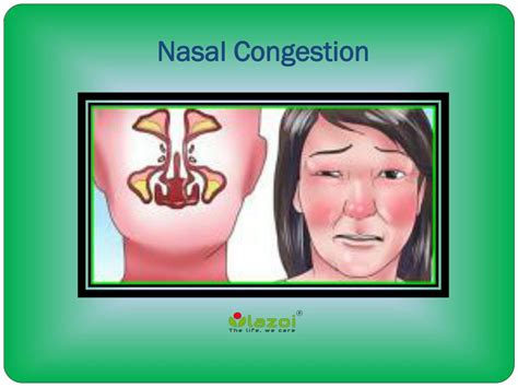 nasal congestion  symptoms diagnosis  treatment