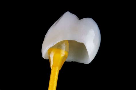 Top 5 Treatments for Fixing a Broken Front Tooth - Asha Dental