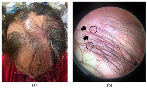 step diagnostic algorithm  alopecia pattern analysis