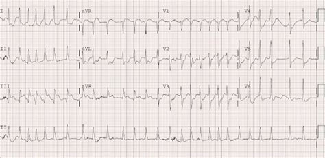 Dr. Smith's ECG Blog: Atrial Fibrillation with RVR and Inferoposterior ...