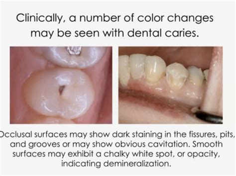 DHY 205 Ch 33 Interpretation Of Dental Caries Flashcards Quizlet