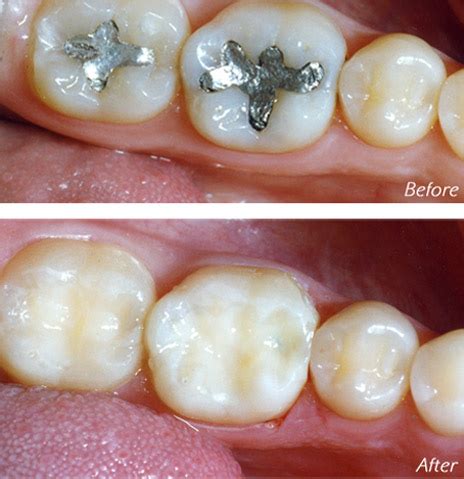 Safe Mercury Dental Filling Removal Jeffrey S Tatarin DDS