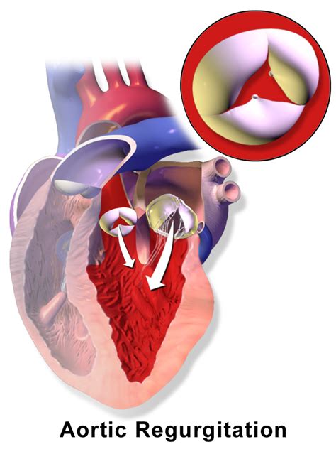 Aortic Valve Regurgitation Causes, Symptoms, Diagnosis and Treatment ...