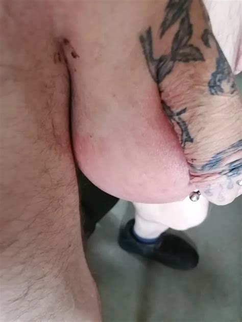 Saline Infusion In Scrotum First Try Liter Nude Pics Xhamster