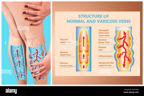 Venas Varicosas En Las Piernas Femeninas De Mayor Edad Concepto De