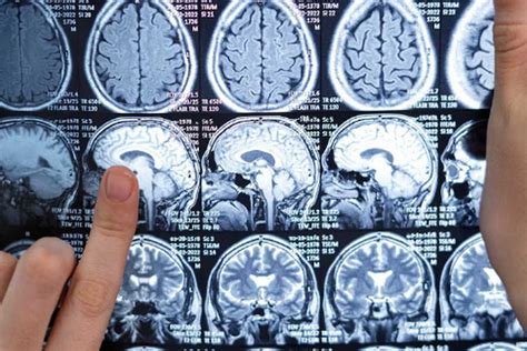 Простой тест, позволяющий распознать инсульт, должен знать каждый