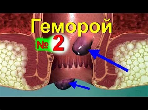 Лечение геморроя народными средствами в домашних условиях - №2 - YouTube