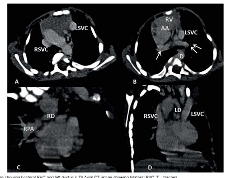 Figure From Non Confluent Pulmonary Arteries With Bilateral Patent