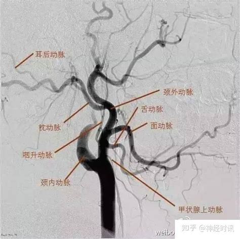 解剖and影像 超详脑供血系统分类 知乎