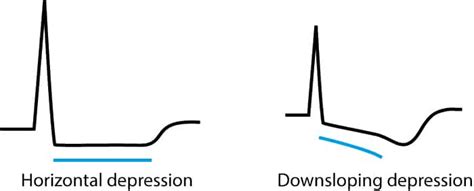 st segment depression  myocardial ischemia  differential diagnoses