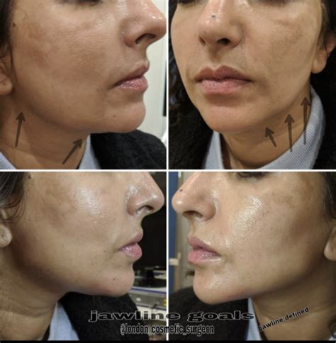 Thread Lifts With Intracel Derma Revive Skin Clinic