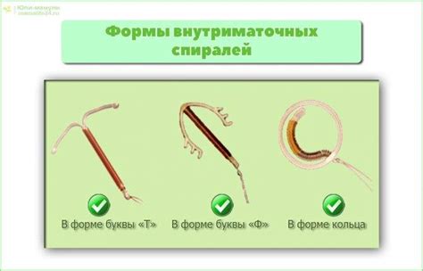 Внутриматочная спираль: виды, цены, как выбрать лучшую - мирена, юнона ...