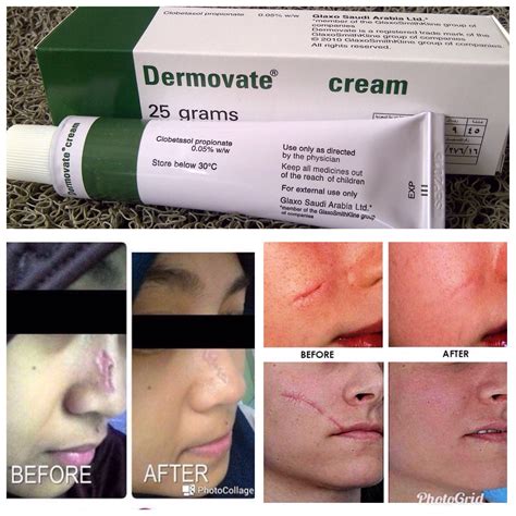 Dermovate Cream Ointment Scar Remover Beauty Personal Care Bath