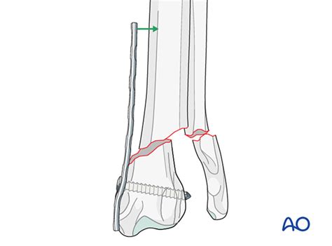 compression plate fixation  simple extraarticular fracture