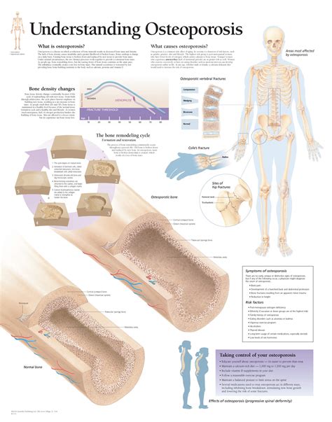 Understanding Osteoporosis | Scientific Publishing