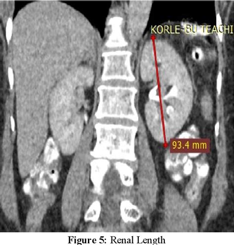 Figure 1 From Measurement Of Renal Dimensions To Determine Standard