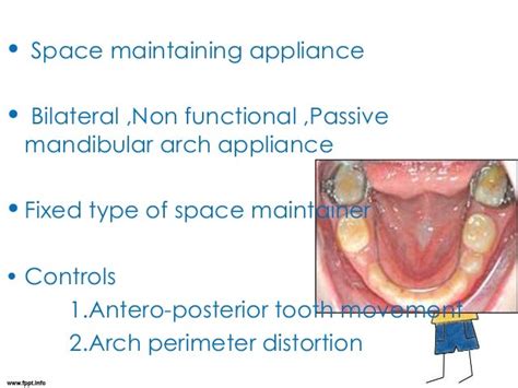 Lingual Holding Arch Space Maintainer