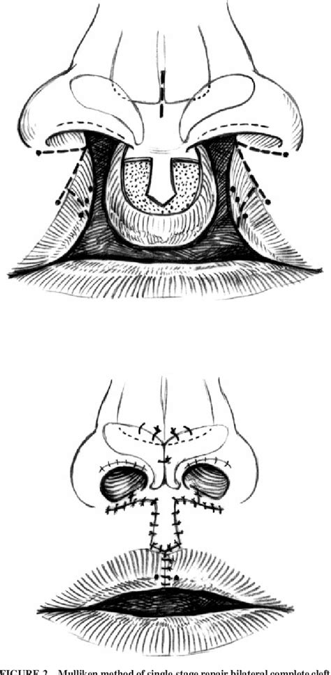 Figure 2 From Repair Of Bilateral Complete Cleft Lip And Nasal Deformity—state Of The Art