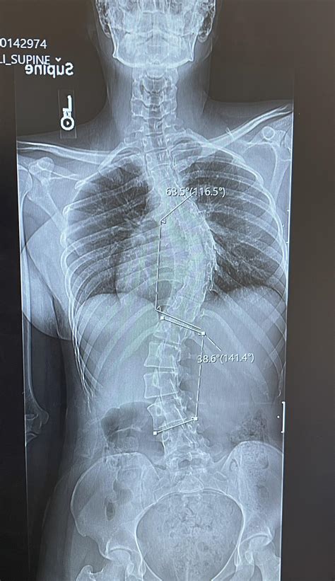 spinal fusion question info  comments rscoliosis