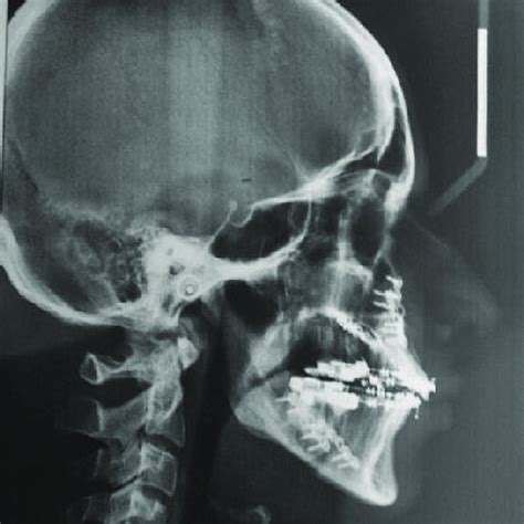 post surgical lateral cephalogram  scientific diagram