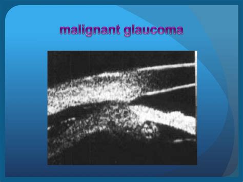 Ppt Ubm Ultrasound Biomicroscopy Powerpoint Presentation Free