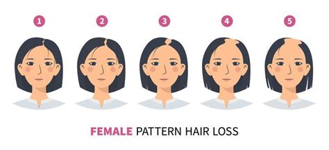 Hair Loss Stages Vector Art, Icons, and Graphics for Free Download