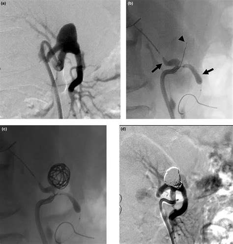 A An Angiography From The Left Renal Artery Shows The Aneurysm Download Scientific Diagram