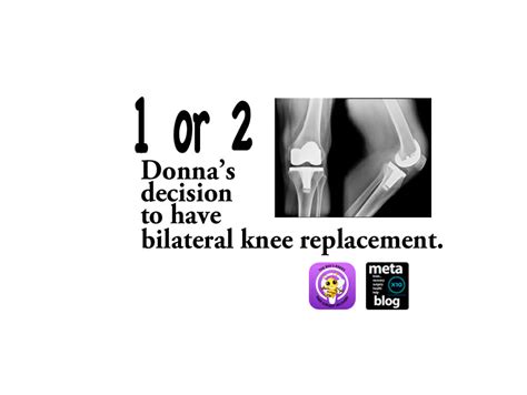 Nine Stories of Bilateral Knee Replacement