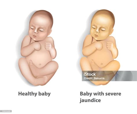 Icterícia Em Bebê De 1 Mês - Vetores de Extensão Da Icterícia Com Bebê e mais imagens de Icterícia ...