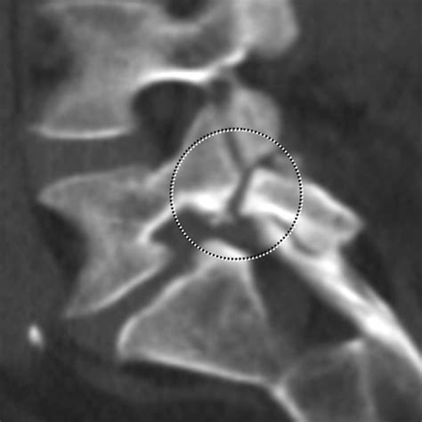 MDCT of Variations and Anomalies of the Neural Arch and Its Processes