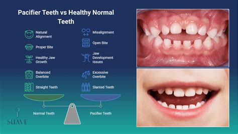 pacifier teeth side effects  treatments  toddlers