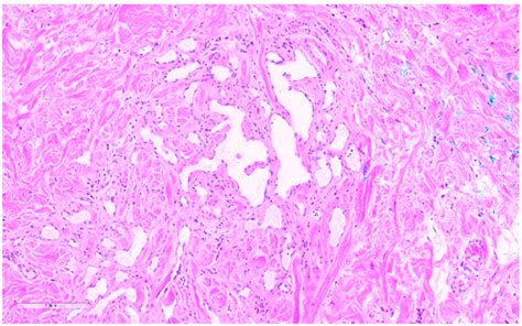 Atypical Vascular Lesion Anastomosed Lymphatic Or Capillary Vessels Download Scientific