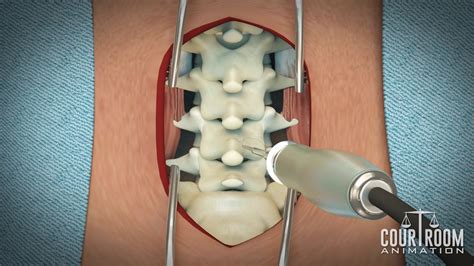 Herniated Disc Surgery Video