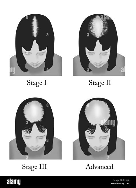 Etapas Progresivas De Pérdida De Cabello En Las Mujeres Basada En La Escala De Ludwig Fotografía