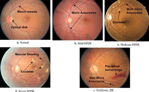 Figure 1 From Hybrid Methods For Fundus Image Analysis For Diagnosis Of