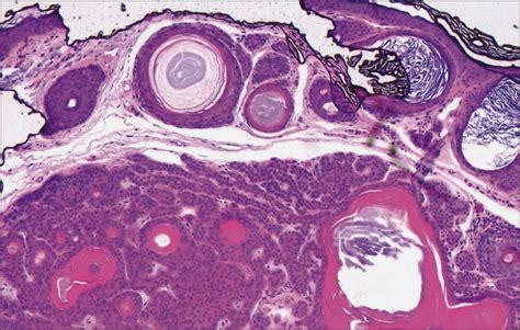 Multiple Facial Papules And Palmar Pits—diagnosis Dermatology Jama