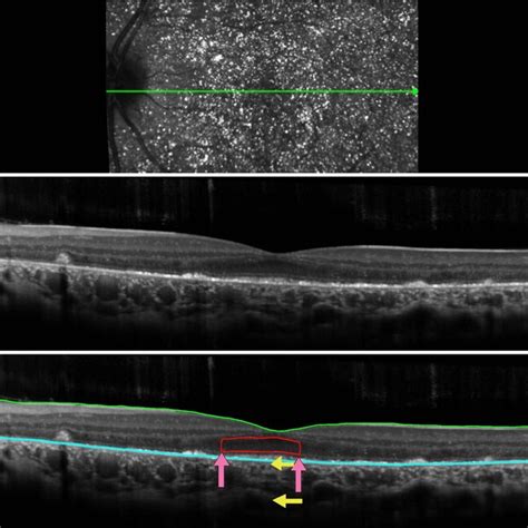 Spectral Domain Optical Coherence Tomography Sd Oct Imaging For