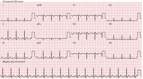 Electrocardiogram Ecg Bayside Medical Group