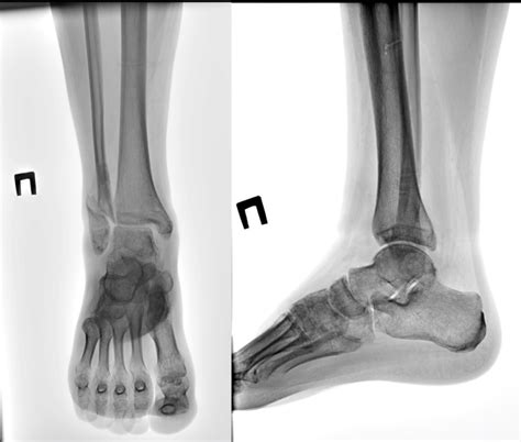 yo male patient  lateral malleolus malunion