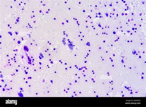 Toxoplasmosis